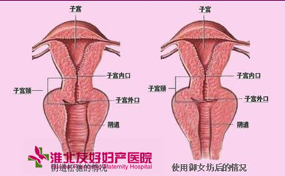 宫颈肥大患者会有哪些典型症状