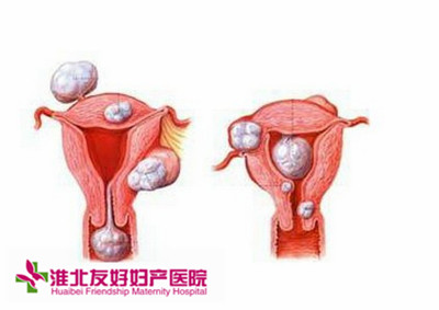 子宫肌瘤对月经有哪些影响?